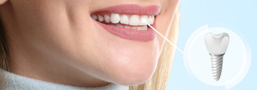 How much do dental implants cost in the UK? (2026 price guide)