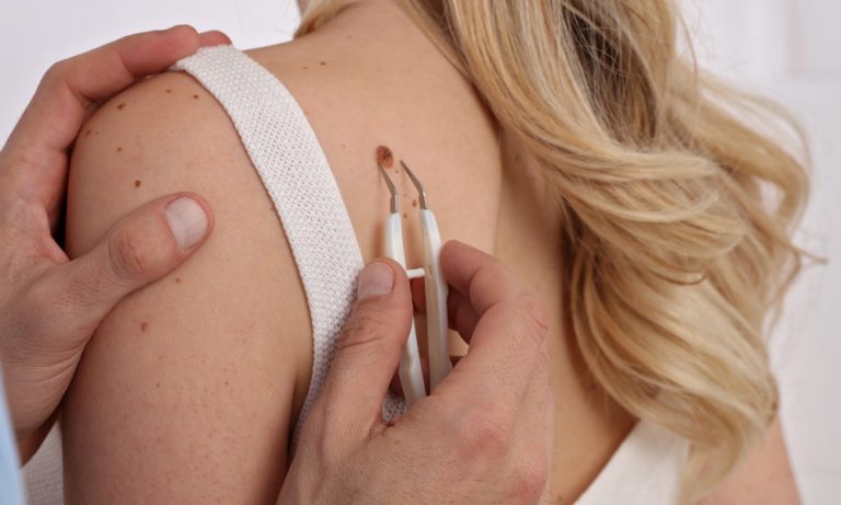 How much does skin tag removal cost in the UK? (2026 price guide)
