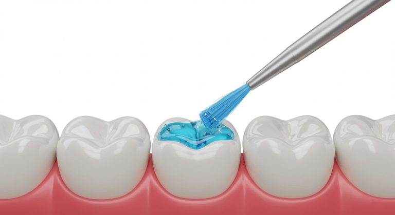 How much does composite bonding cost in the UK? (2026 price guide)