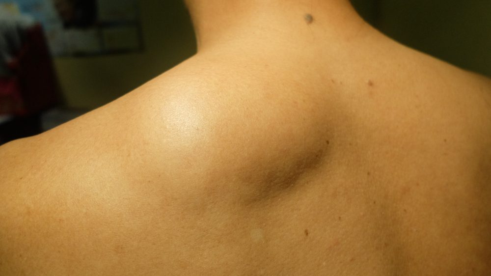 How much does lipoma removal cost in the UK? (2026 price guide)
