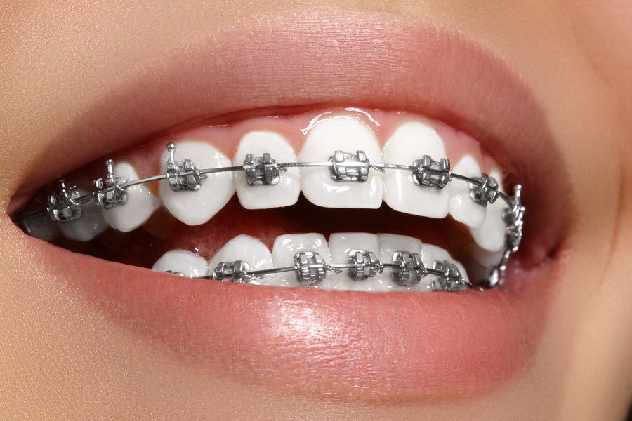 How much do braces cost in the UK? (2026 price guide)