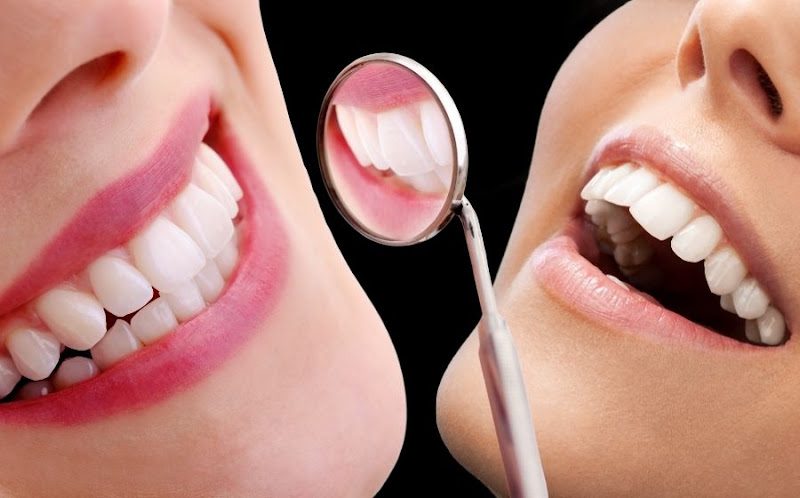 Composite bonding vs veneers: cost, difference and which to choose (2026)