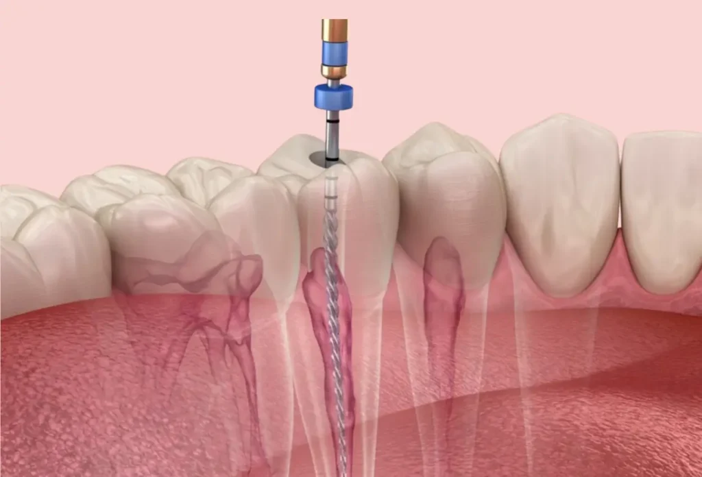 How much does a root canal cost in the UK? (2026 price guide)