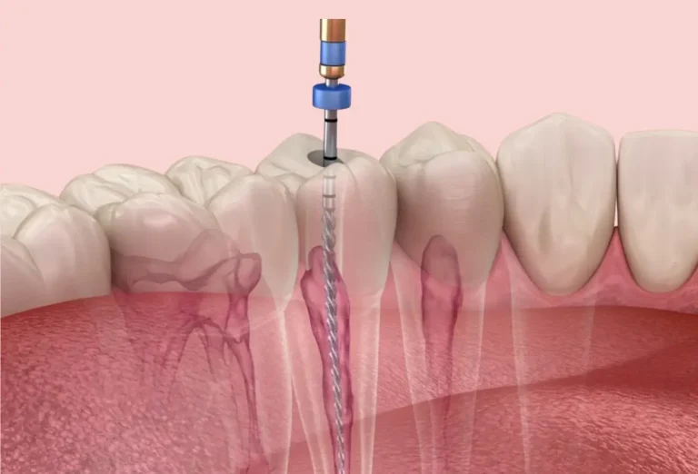 How much does a root canal cost in the UK? (2026 price guide)
