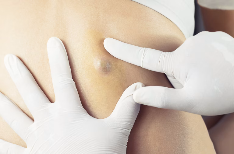 How much does cyst removal cost in the UK? (2026 price guide)