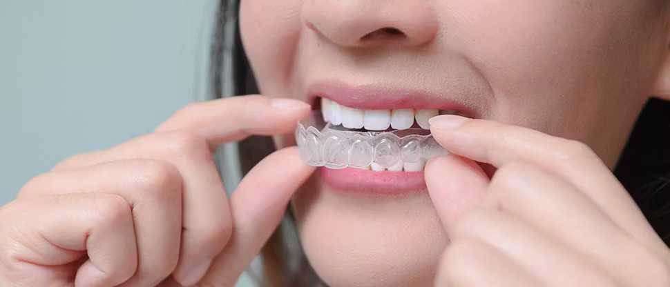 How much does Invisalign cost in the UK? (2026 price guide)