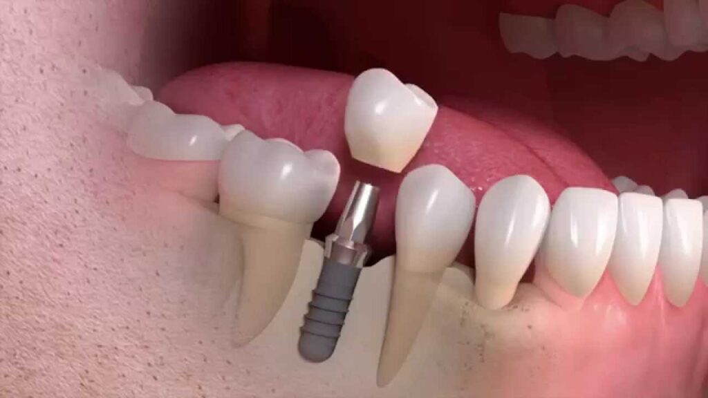How much does a single tooth implant cost in the UK? (2026 price guide)
